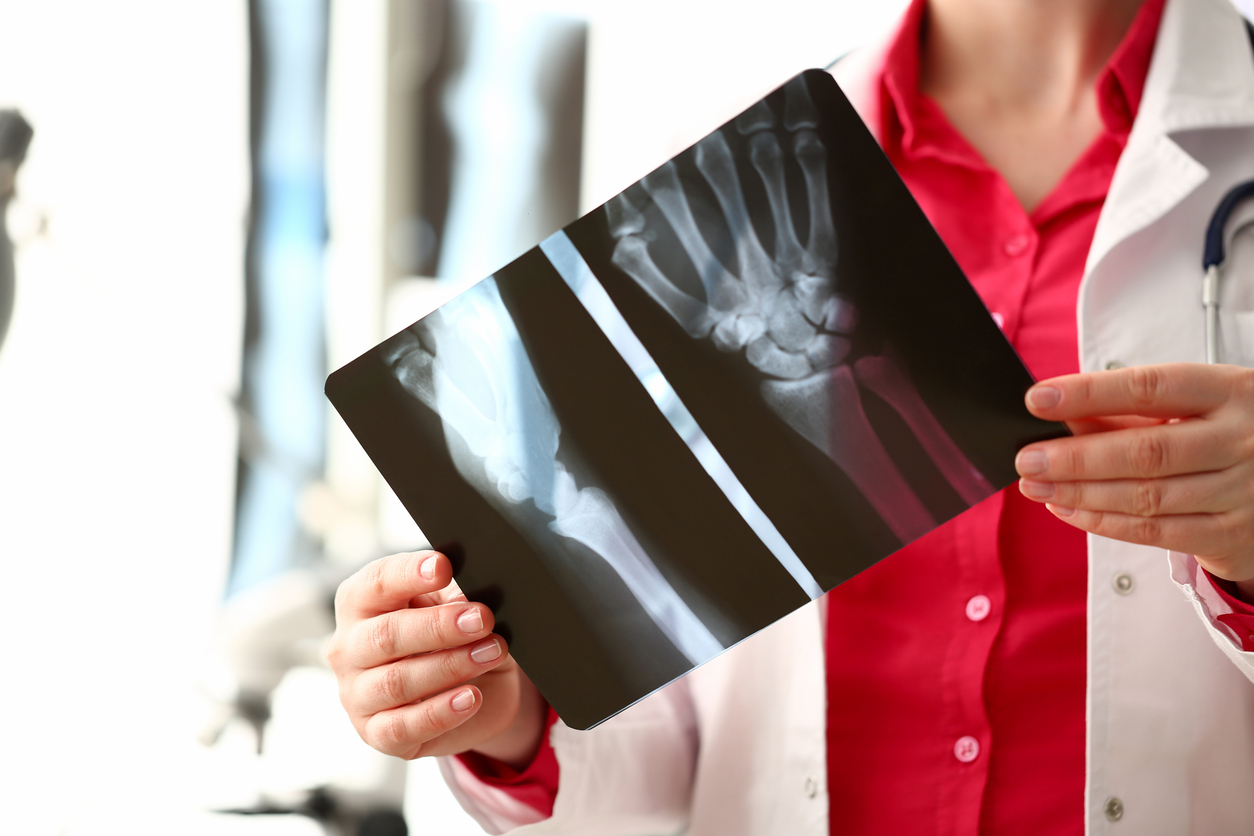 Broken Bones Parker Law Firm